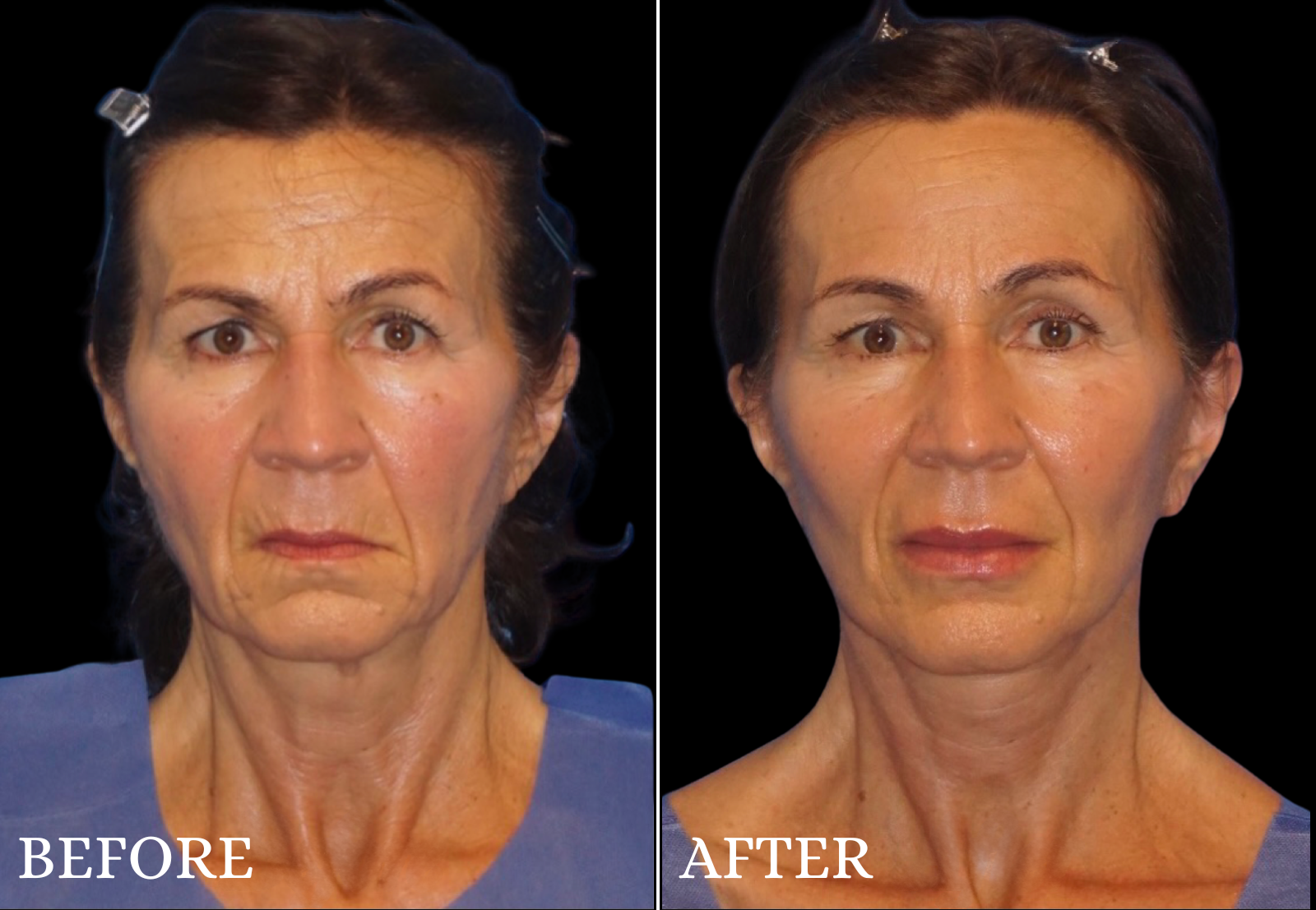 Facelift Before & After Gallery - Patient 241959 - Image 1