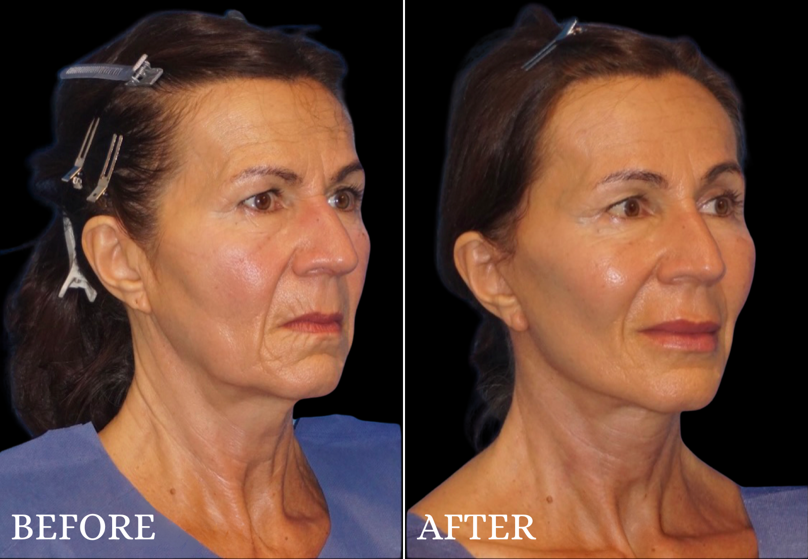 Neck Lift Before & After Gallery - Patient 423522 - Image 4