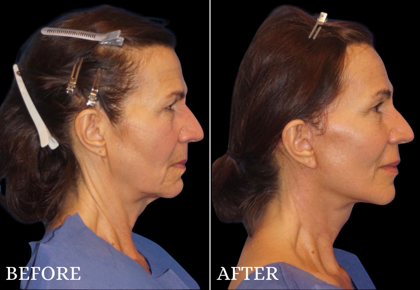 Neck Lift Before & After Gallery - Patient 423522 - Image 5