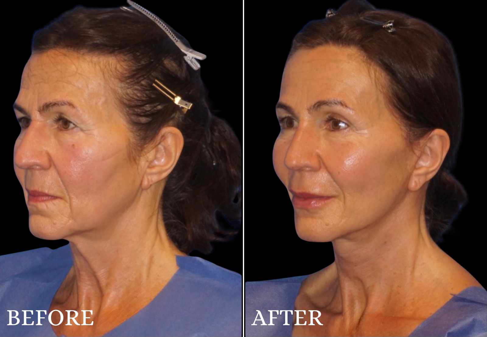 Neck Lift Before & After Gallery - Patient 423522 - Image 2