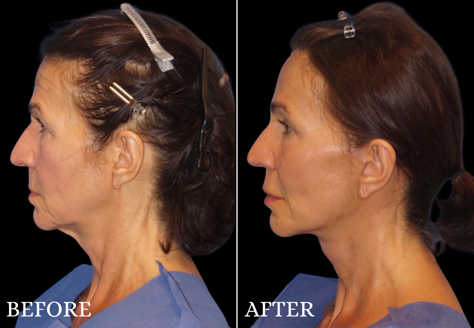 Neck Lift Before & After Gallery - Patient 423522 - Image 1