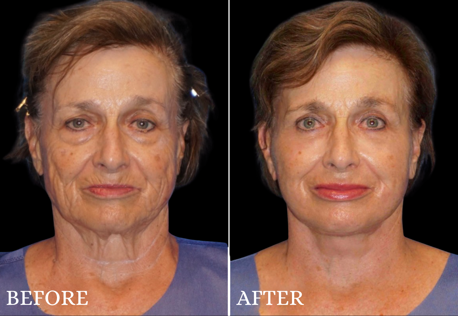 Facelift Before & After Gallery - Patient 347802 - Image 1