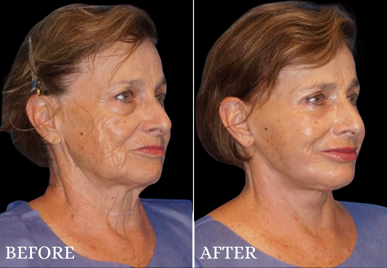 Facelift Before & After Gallery - Patient 347802 - Image 2