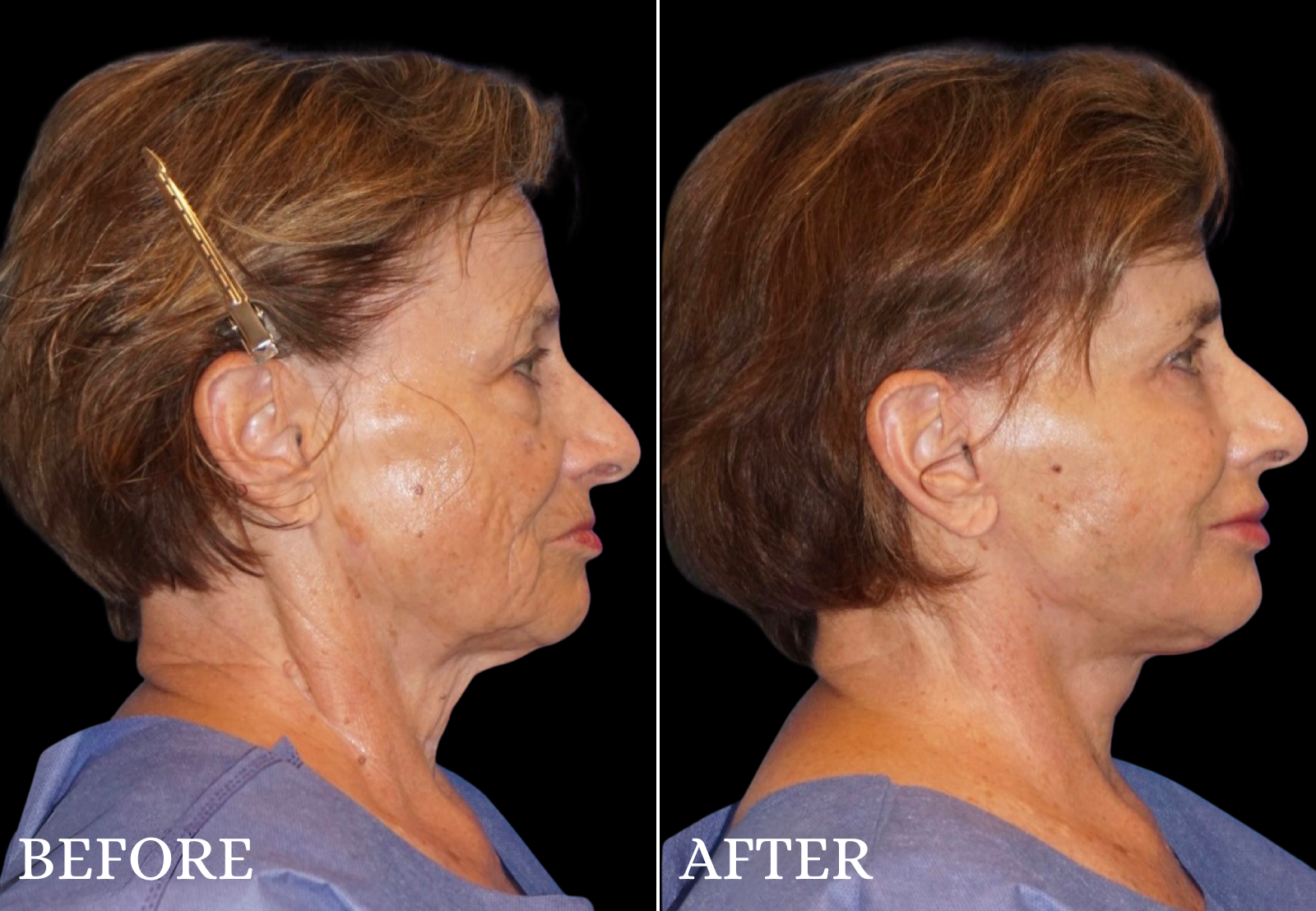 Facelift Before & After Gallery - Patient 347802 - Image 3