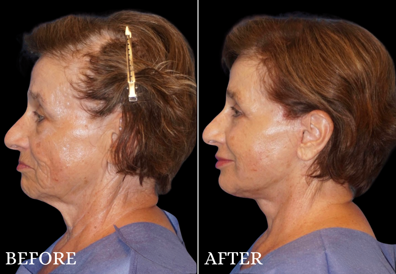 Neck Lift Before & After Gallery - Patient 405771 - Image 1