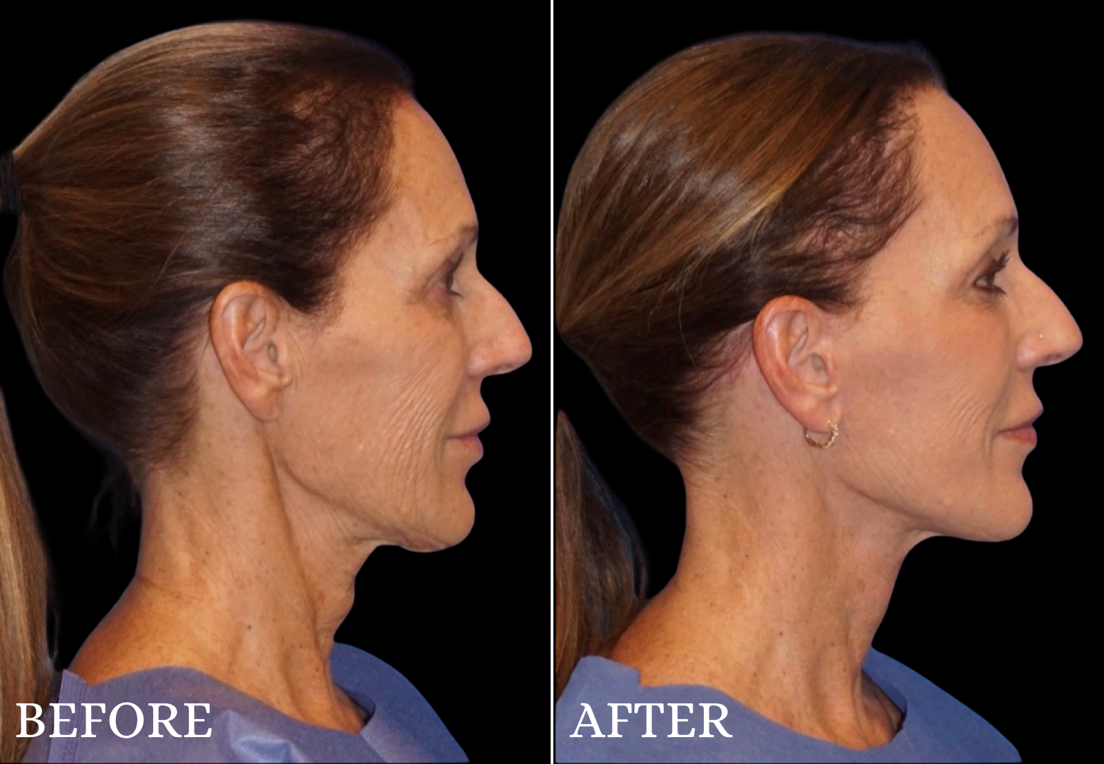 Facelift Before & After Gallery - Patient 426443 - Image 3