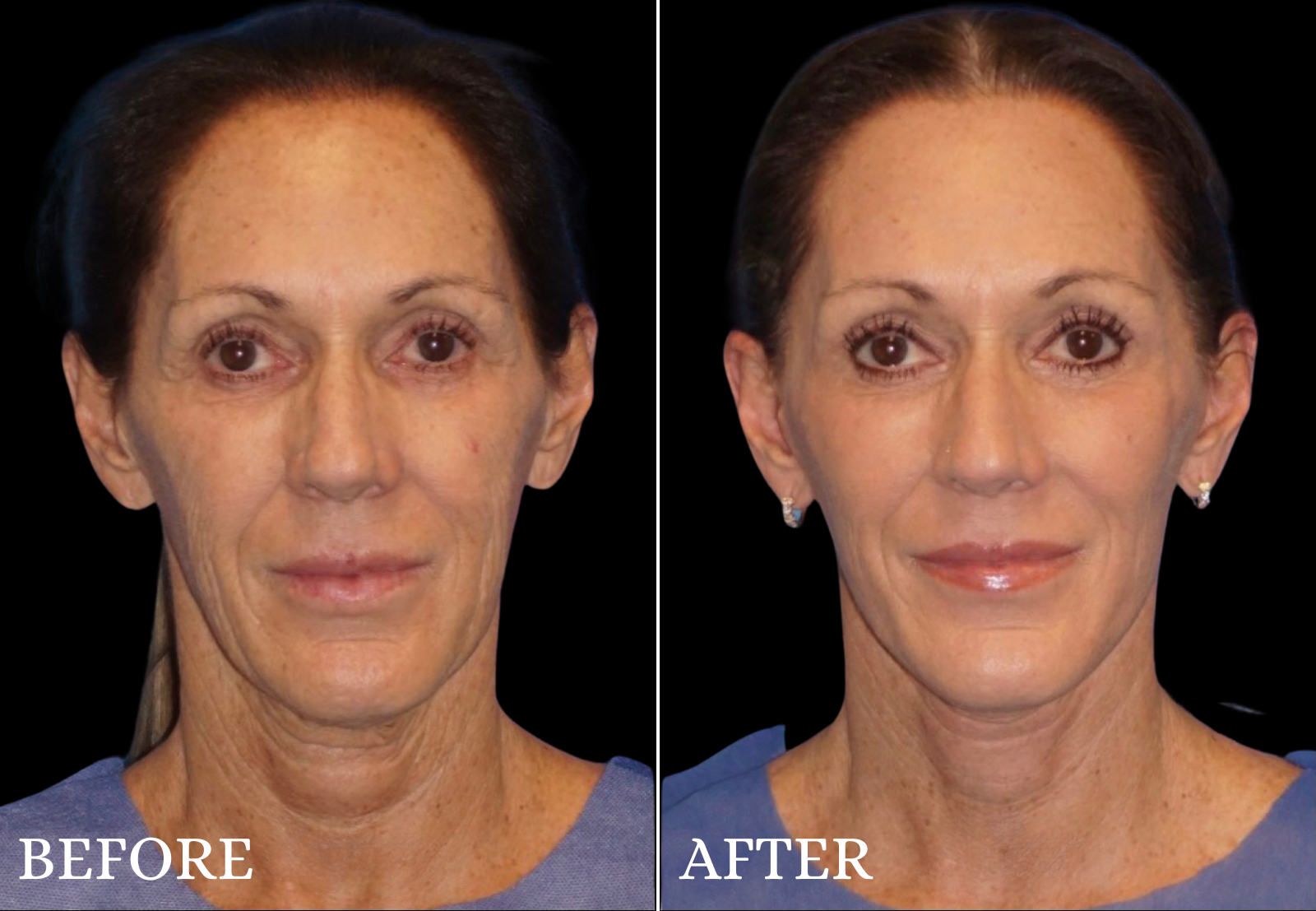 Facelift Before & After Gallery - Patient 426443 - Image 1