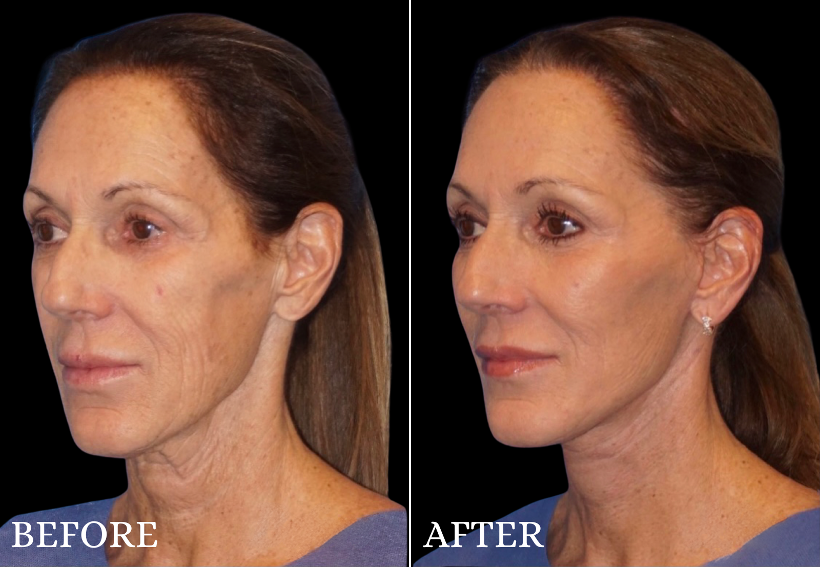 Facelift Before & After Gallery - Patient 426443 - Image 4