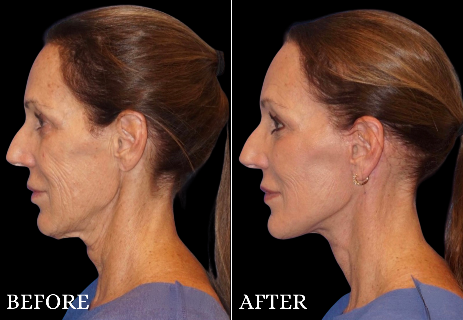Neck Lift Before & After Gallery - Patient 129578 - Image 1