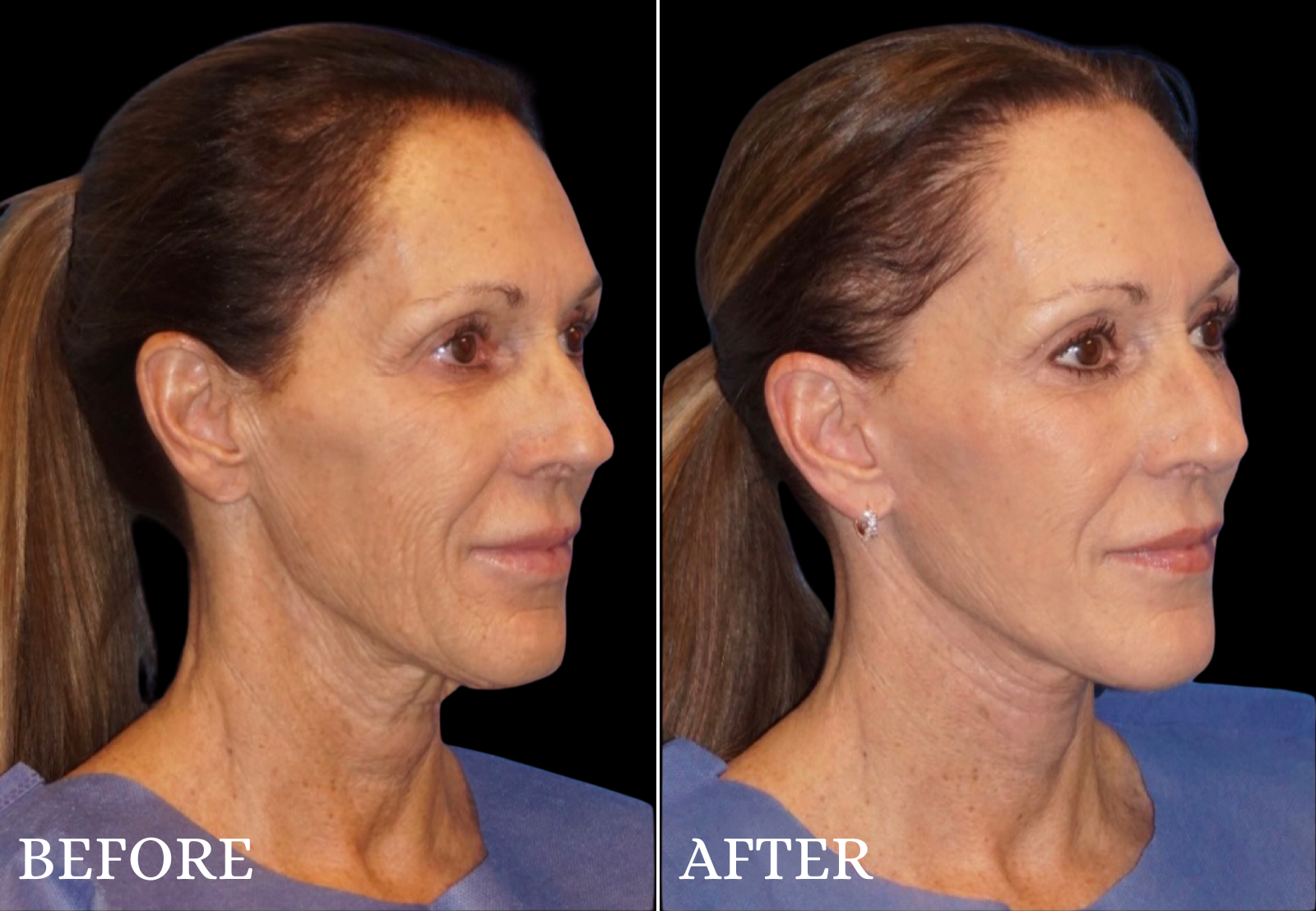 Facelift Before & After Gallery - Patient 426443 - Image 2