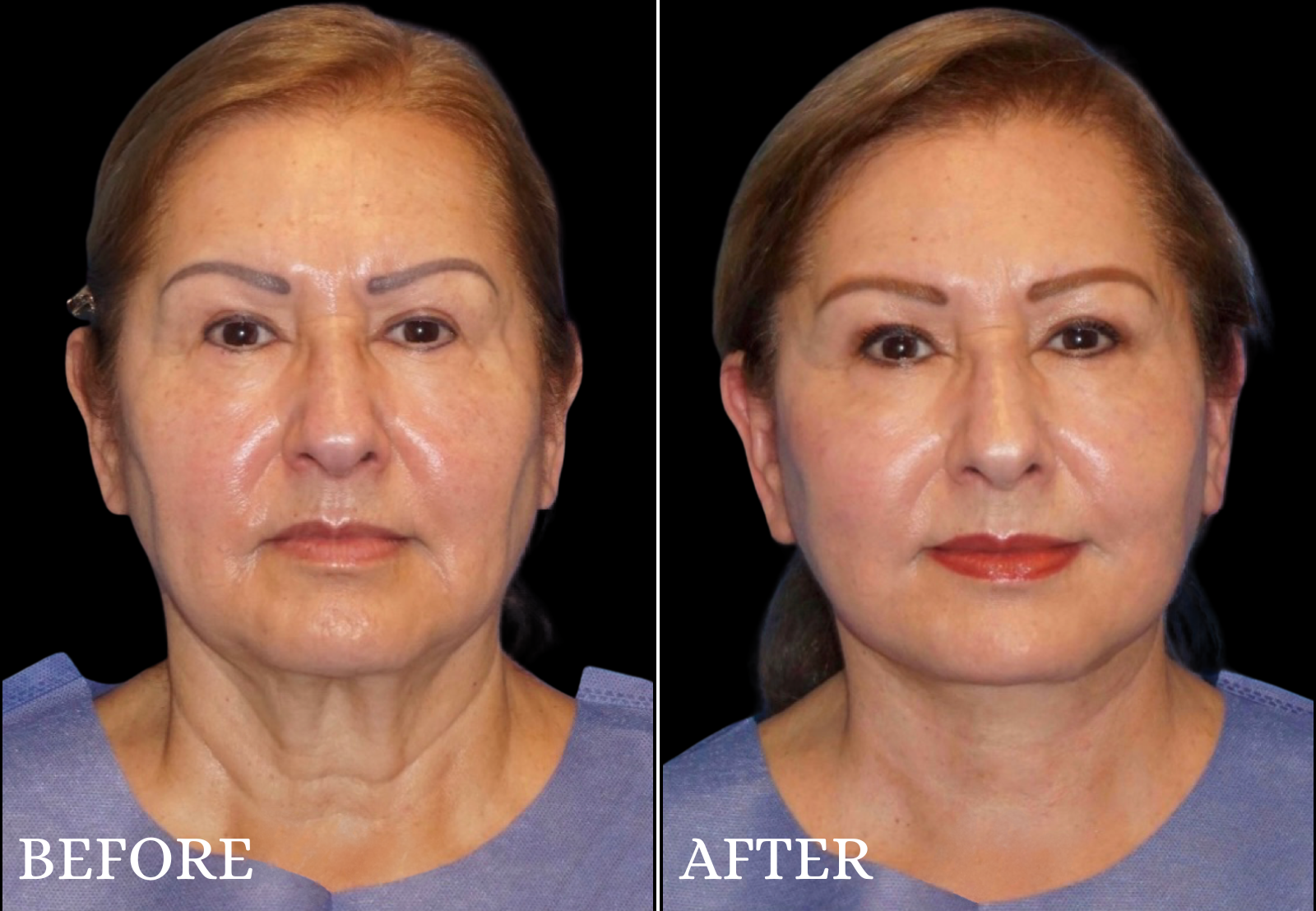 Facelift Before & After Gallery - Patient 406101 - Image 1