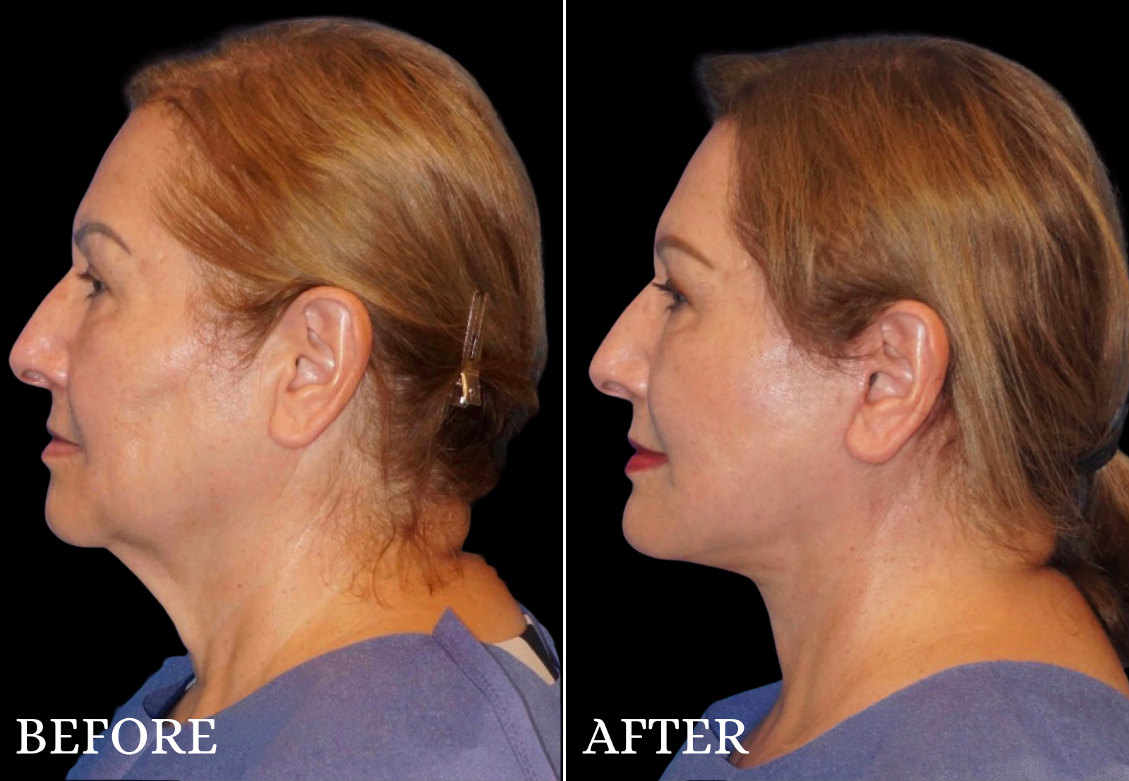 Neck Lift Before & After Gallery - Patient 337627 - Image 1