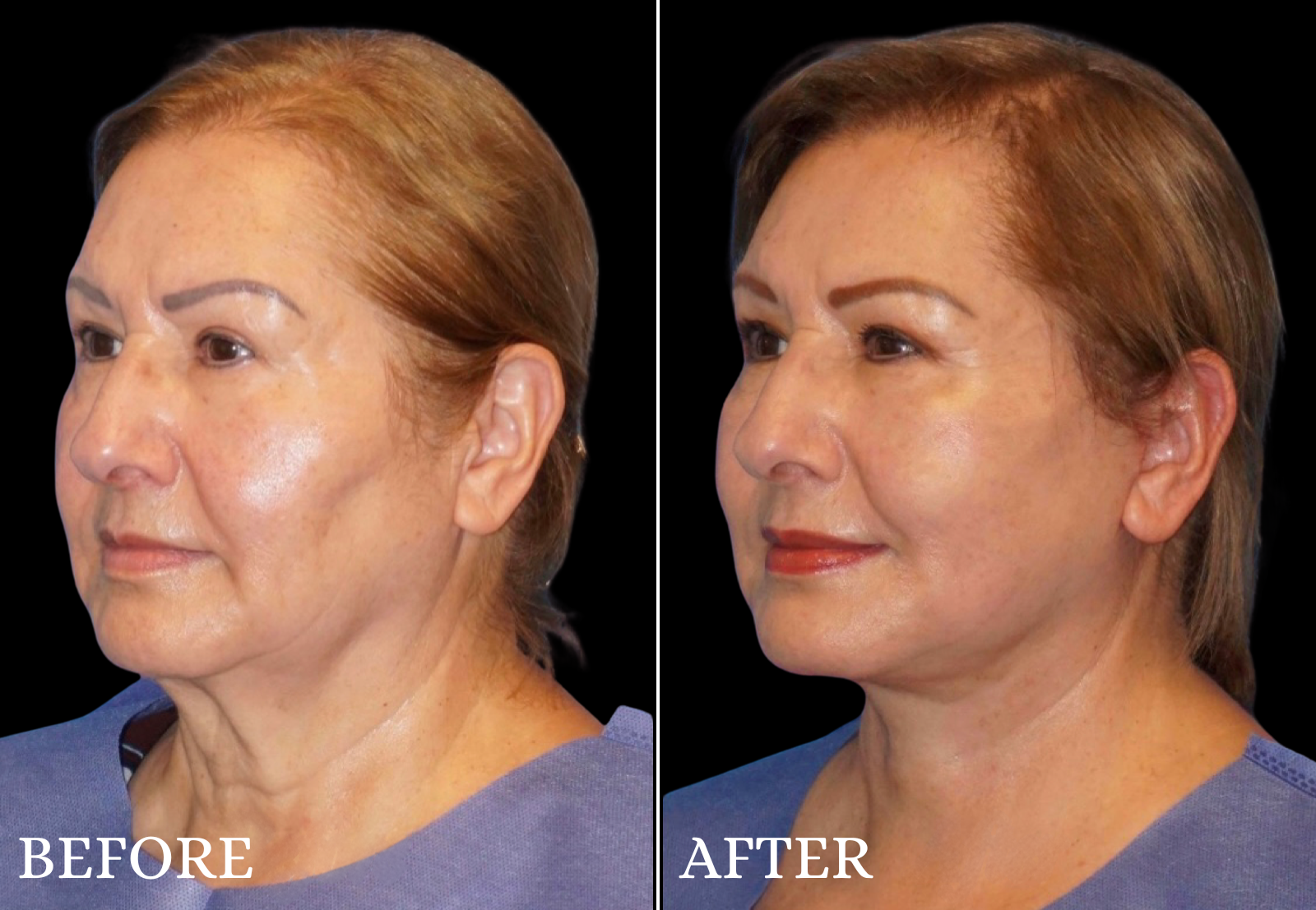 Facelift Before & After Gallery - Patient 406101 - Image 2