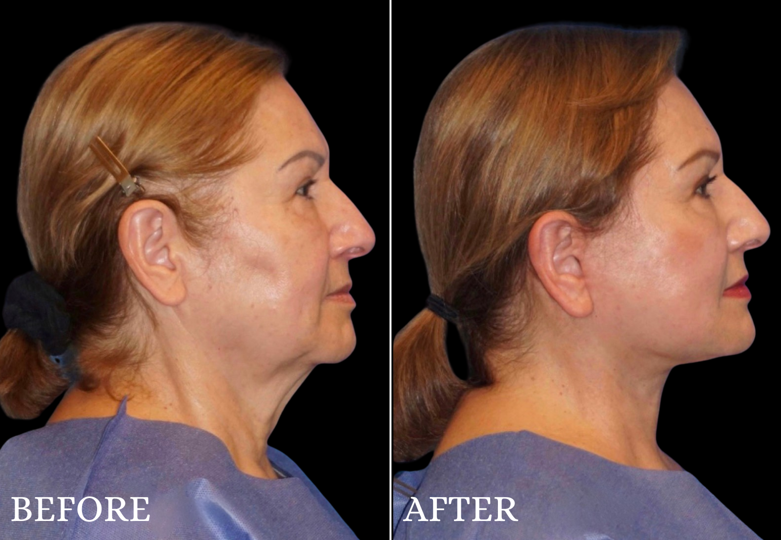 Facelift Before & After Gallery - Patient 406101 - Image 4