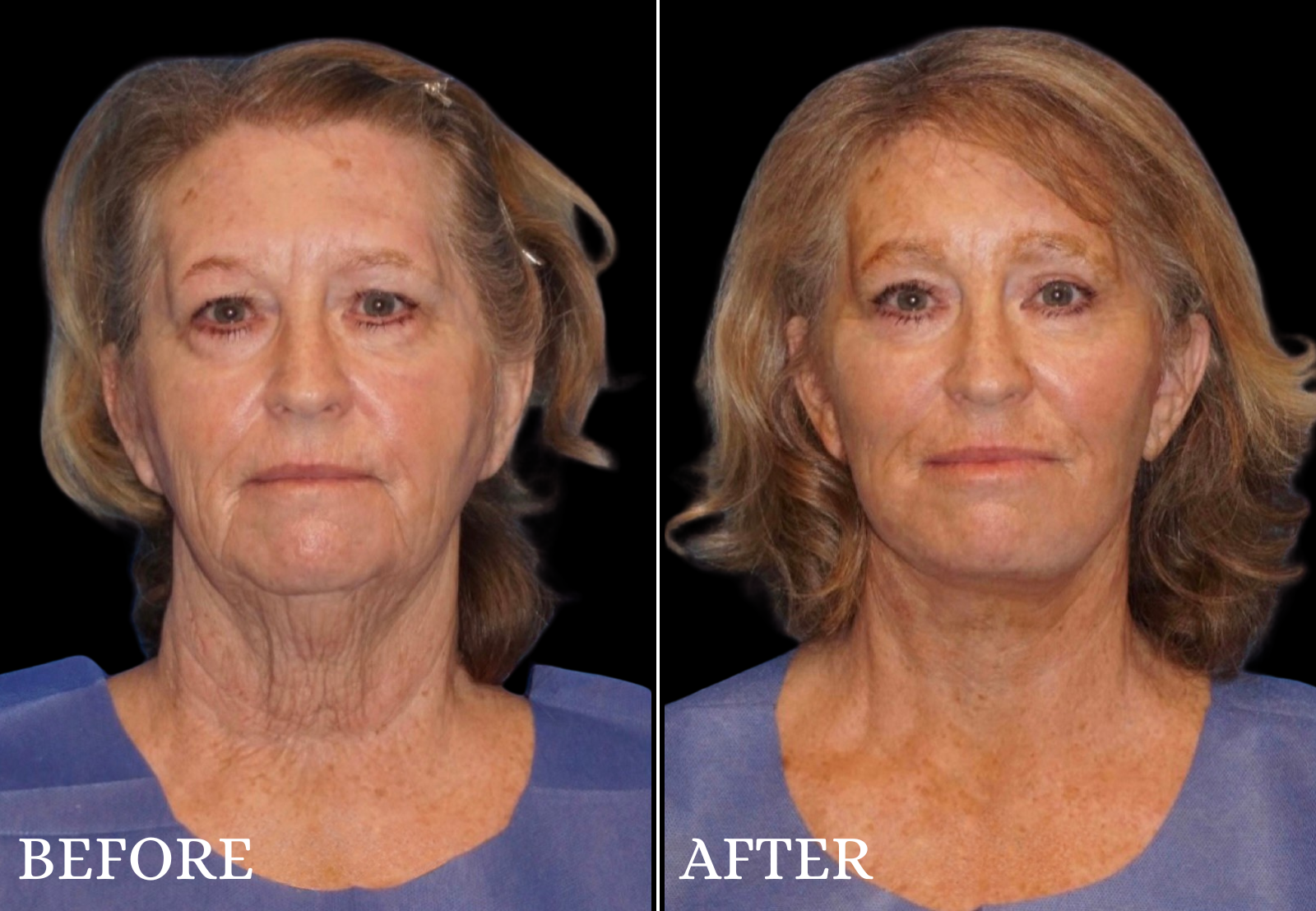 Facelift Before & After Gallery - Patient 176485 - Image 1