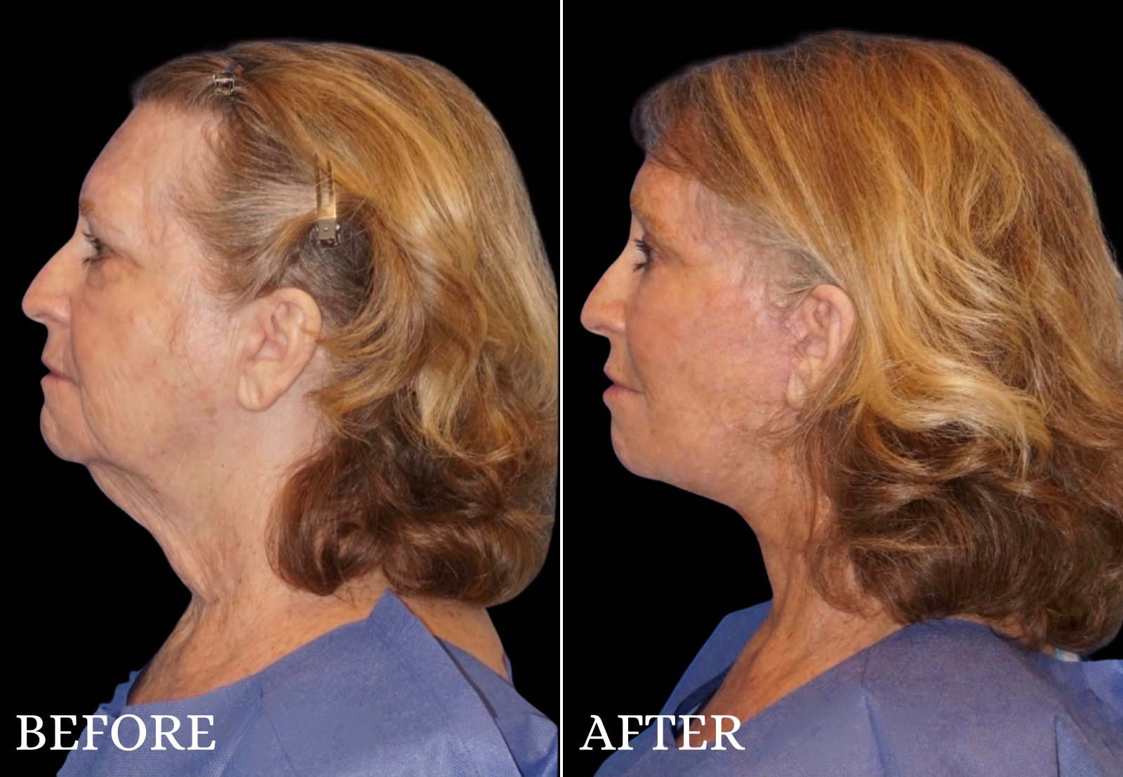 Neck Lift Before & After Gallery - Patient 348616 - Image 1