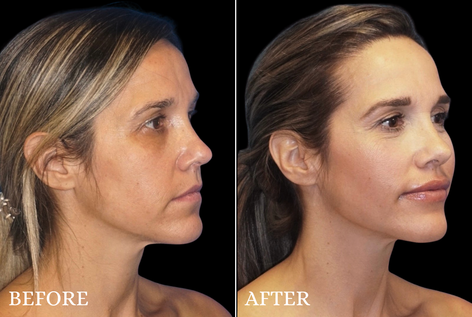 Facial Fat Grafting Before & After Gallery - Patient 553372 - Image 2