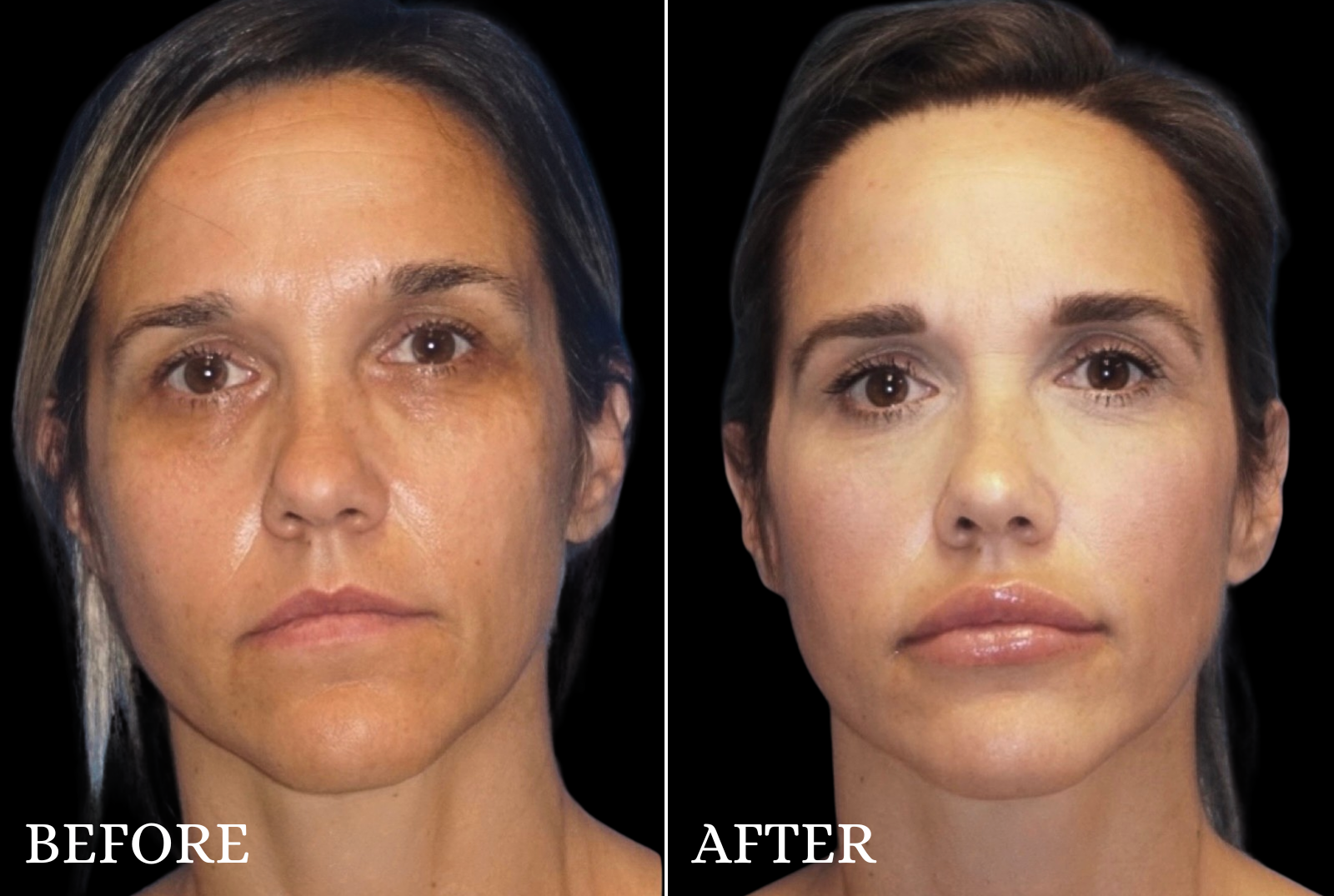 Facial Fat Grafting Before & After Gallery - Patient 553372 - Image 1