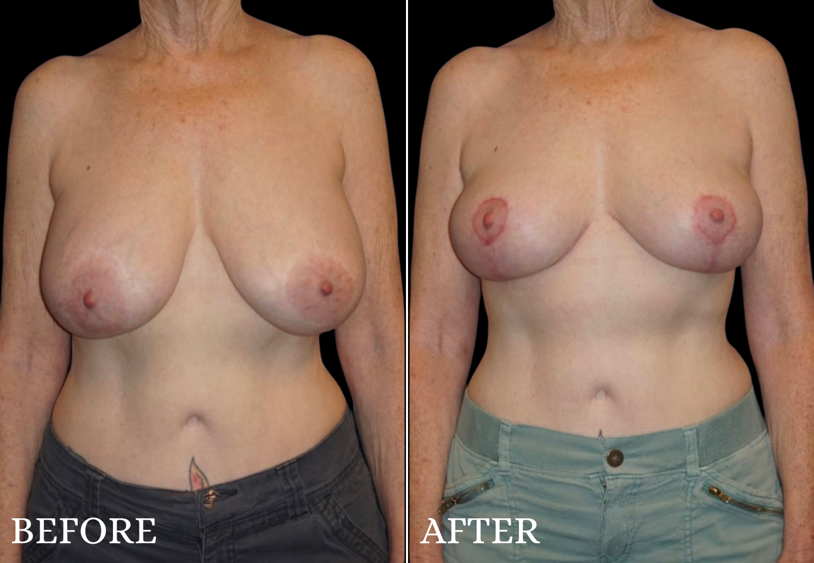 Breast Implant Removal Before & After Gallery - Patient 145833 - Image 1