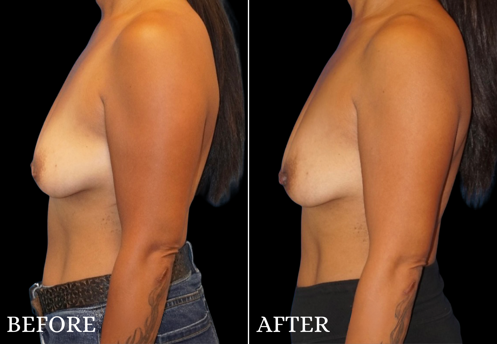 Inverted Nipple Repair Before & After Gallery - Patient 102617 - Image 1
