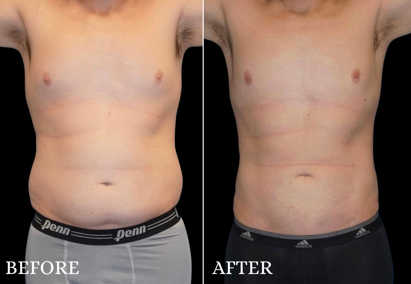 Liposuction Before & After Gallery - Patient 110504 - Image 1