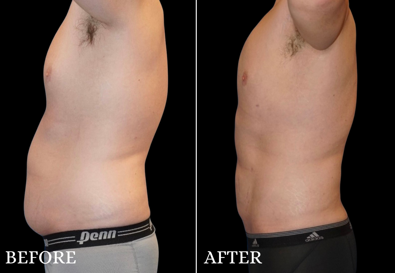 Liposuction Before & After Gallery - Patient 110504 - Image 4