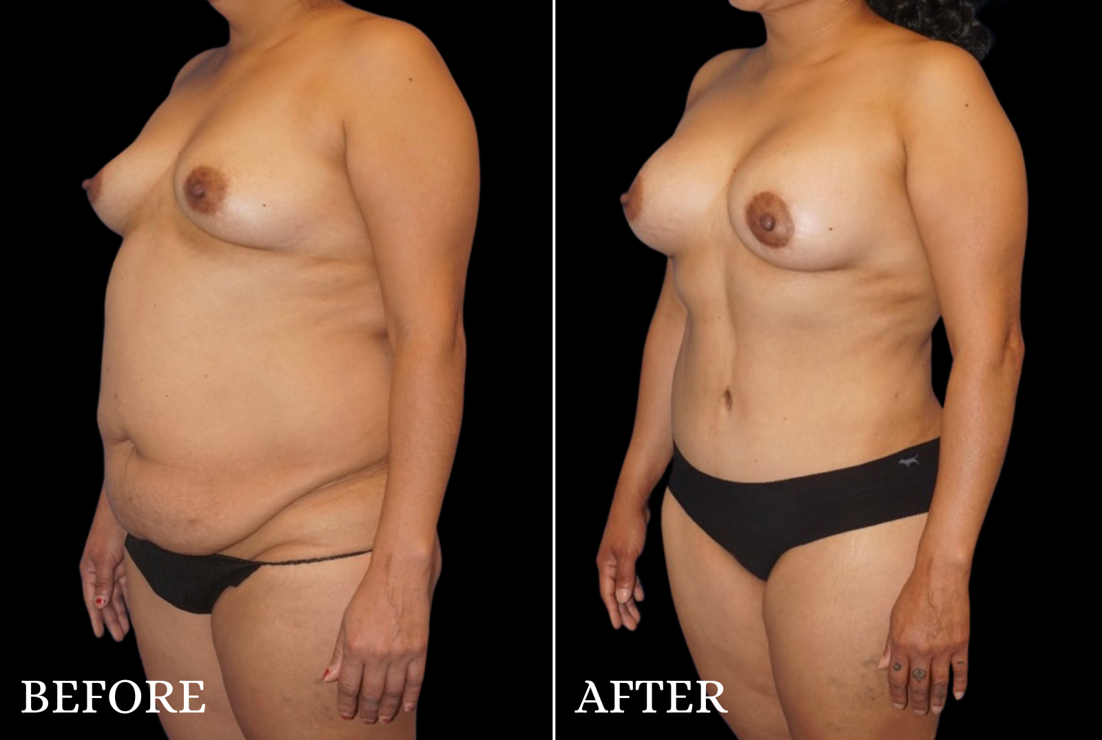 Mommy Makeover Before & After Gallery - Patient 153700 - Image 4