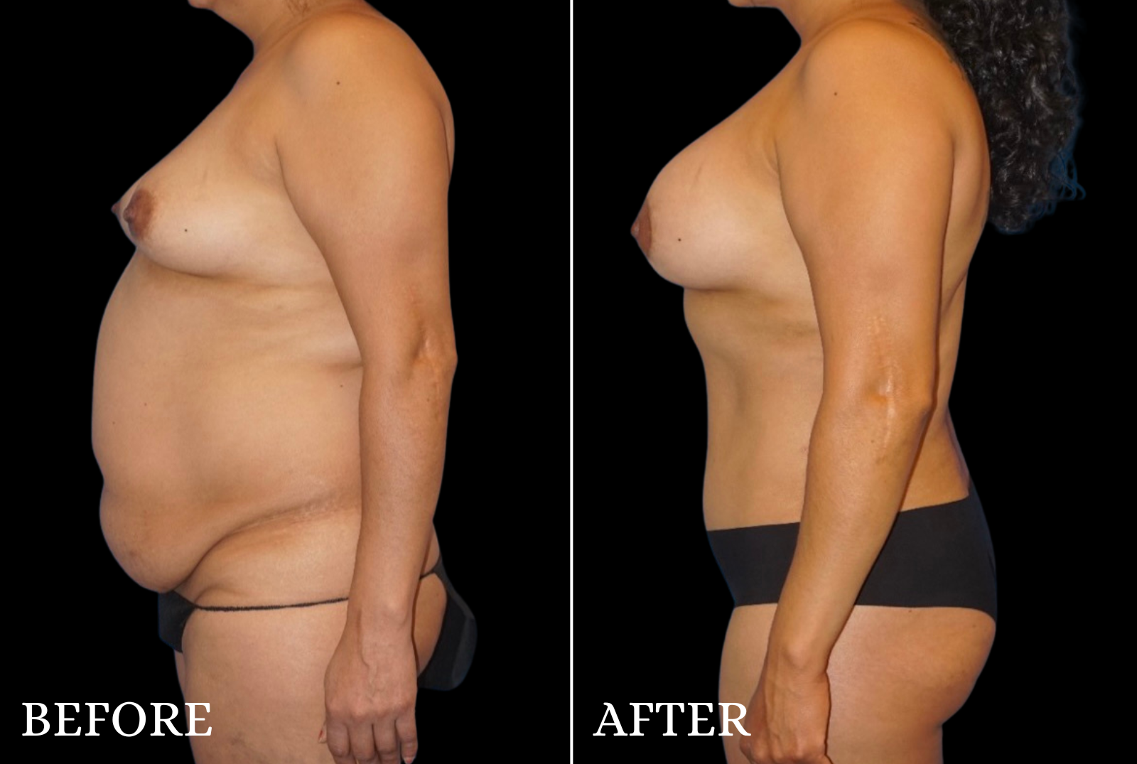 Mommy Makeover Before & After Gallery - Patient 153700 - Image 5