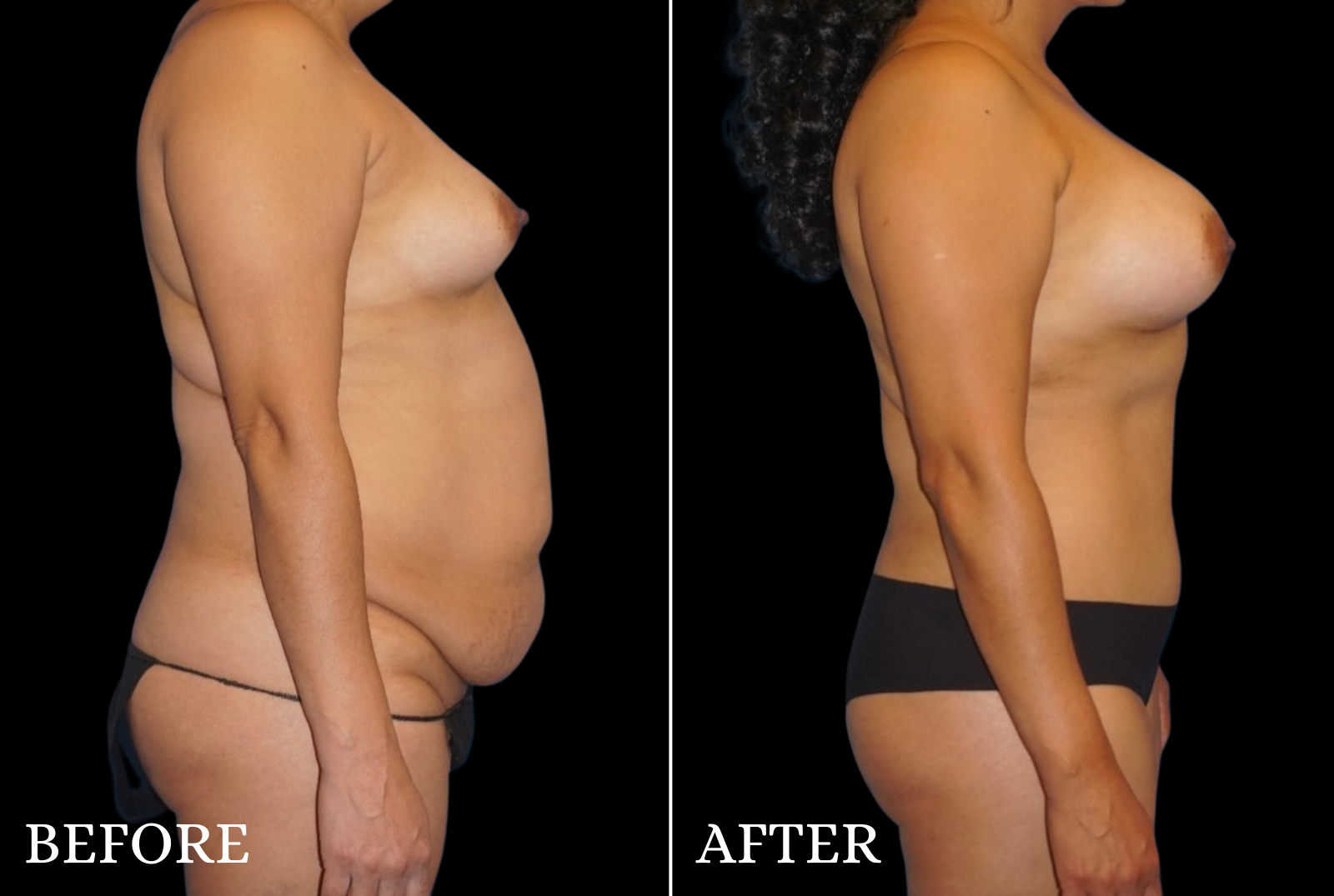 Mommy Makeover Before & After Gallery - Patient 153700 - Image 3