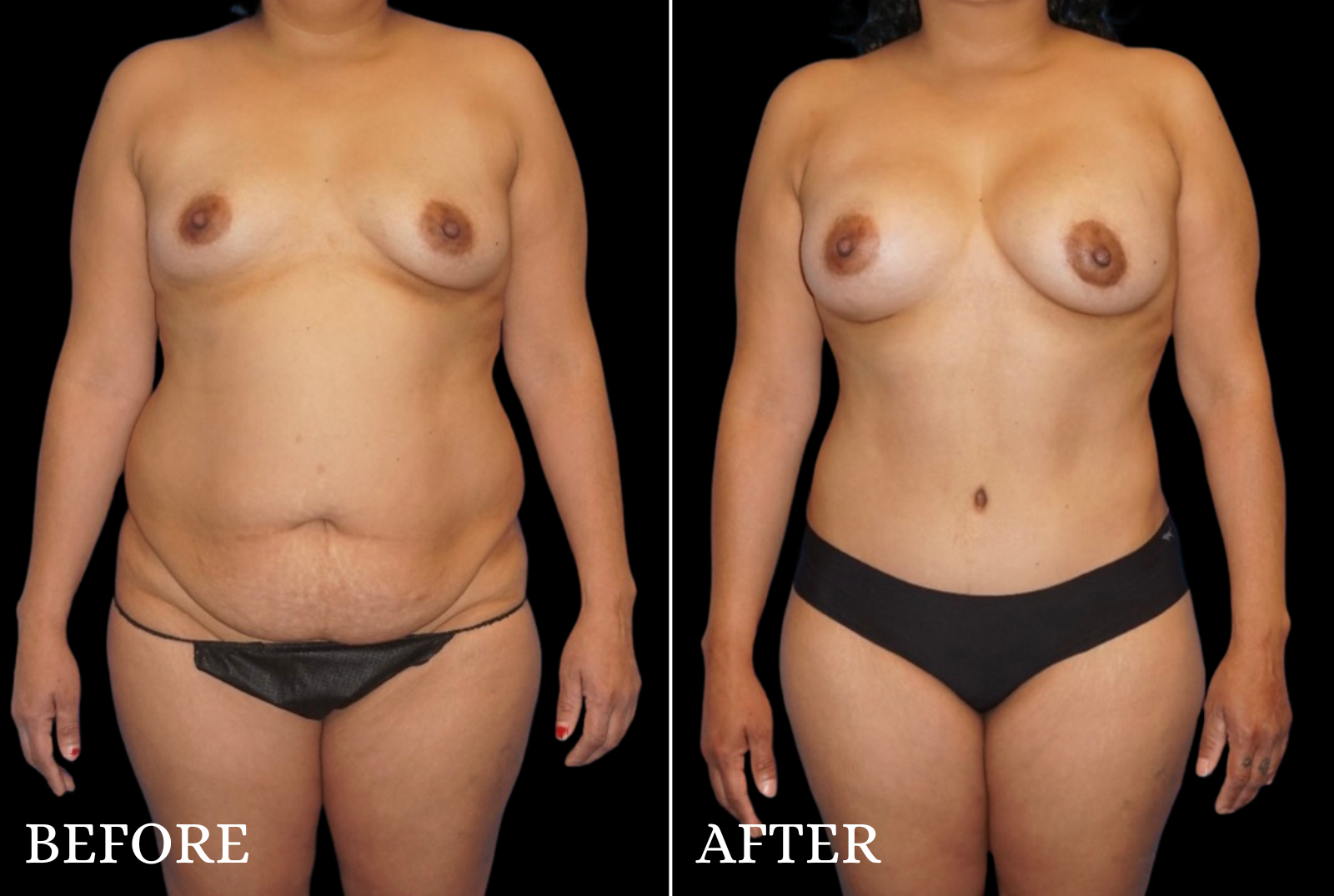 Tummy Tuck Before & After Gallery - Patient 385630 - Image 1