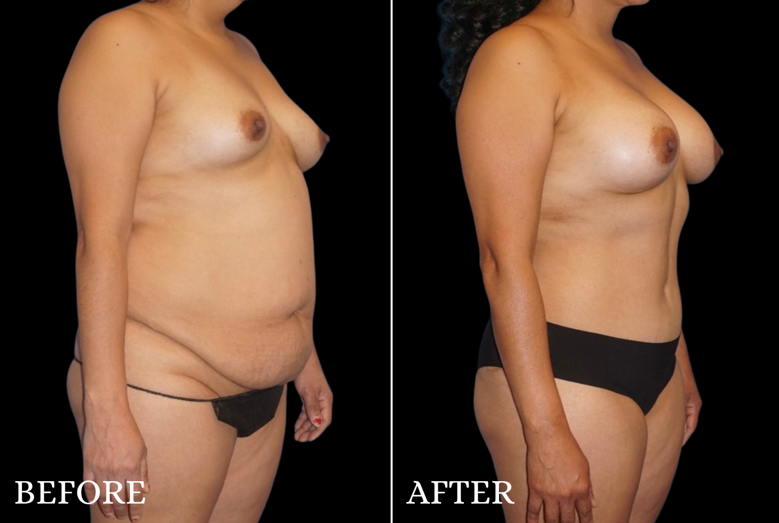 Mommy Makeover Before & After Gallery - Patient 153700 - Image 2