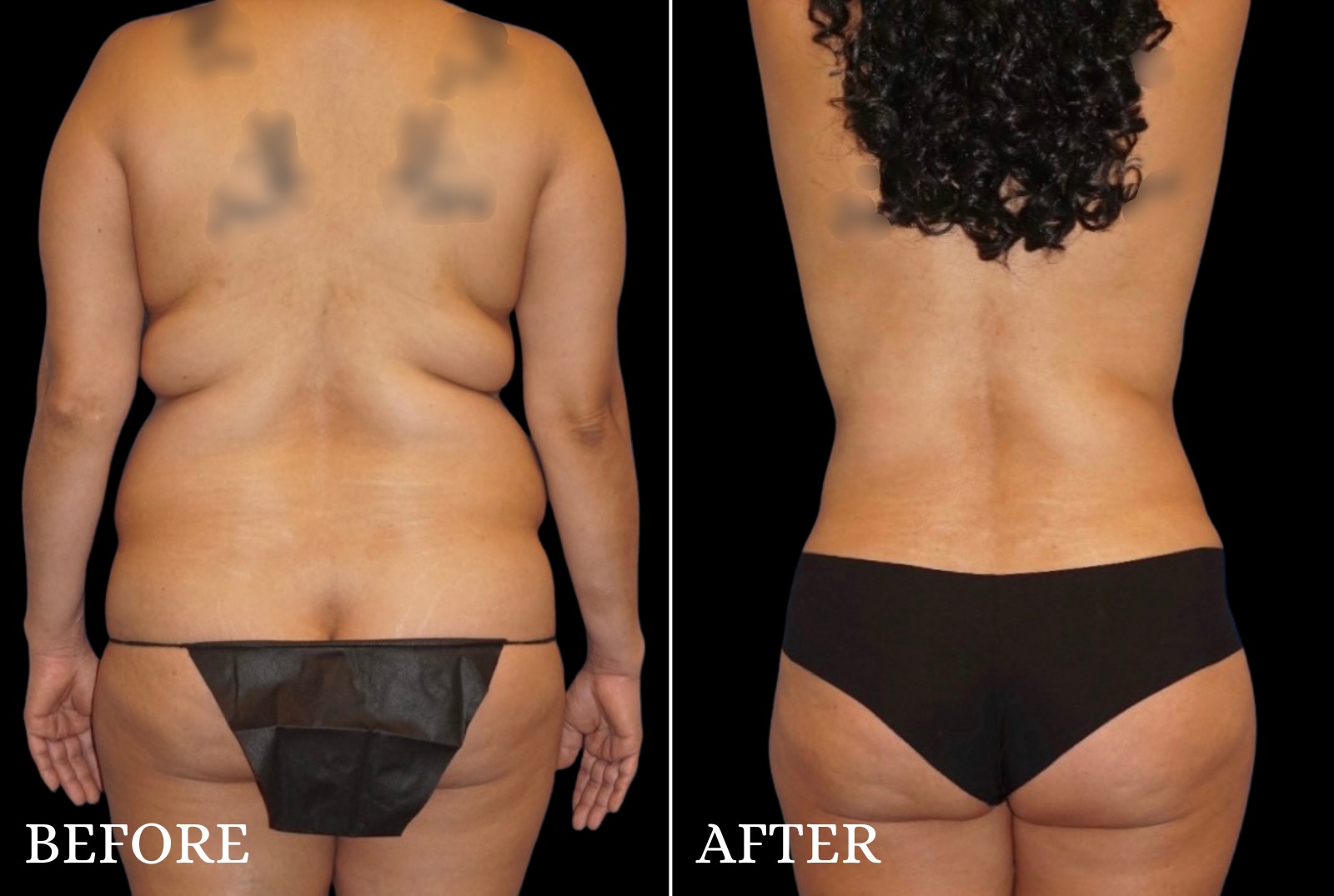 Mommy Makeover Before & After Gallery - Patient 153700 - Image 6