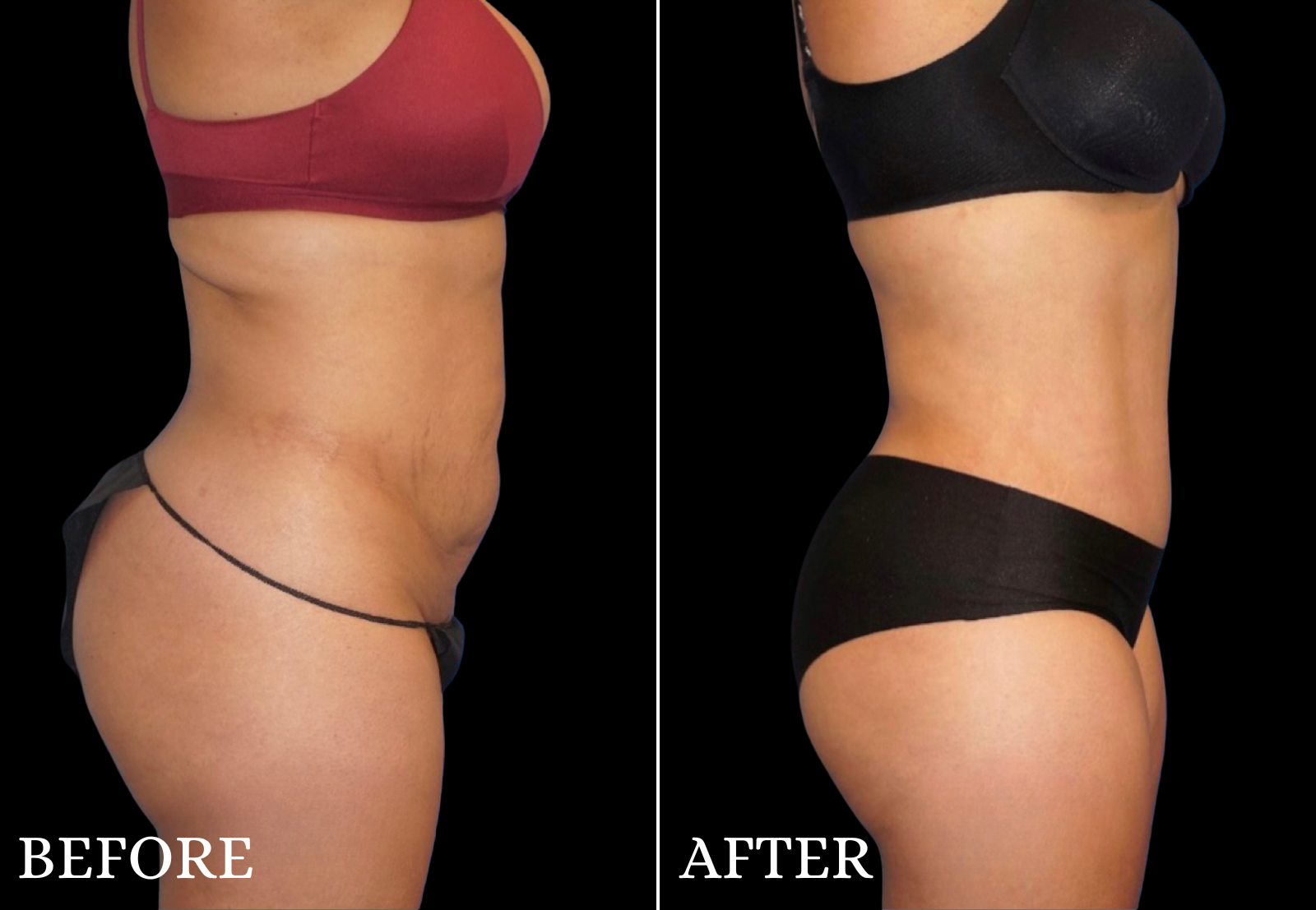 Liposuction Before & After Gallery - Patient 109752 - Image 1