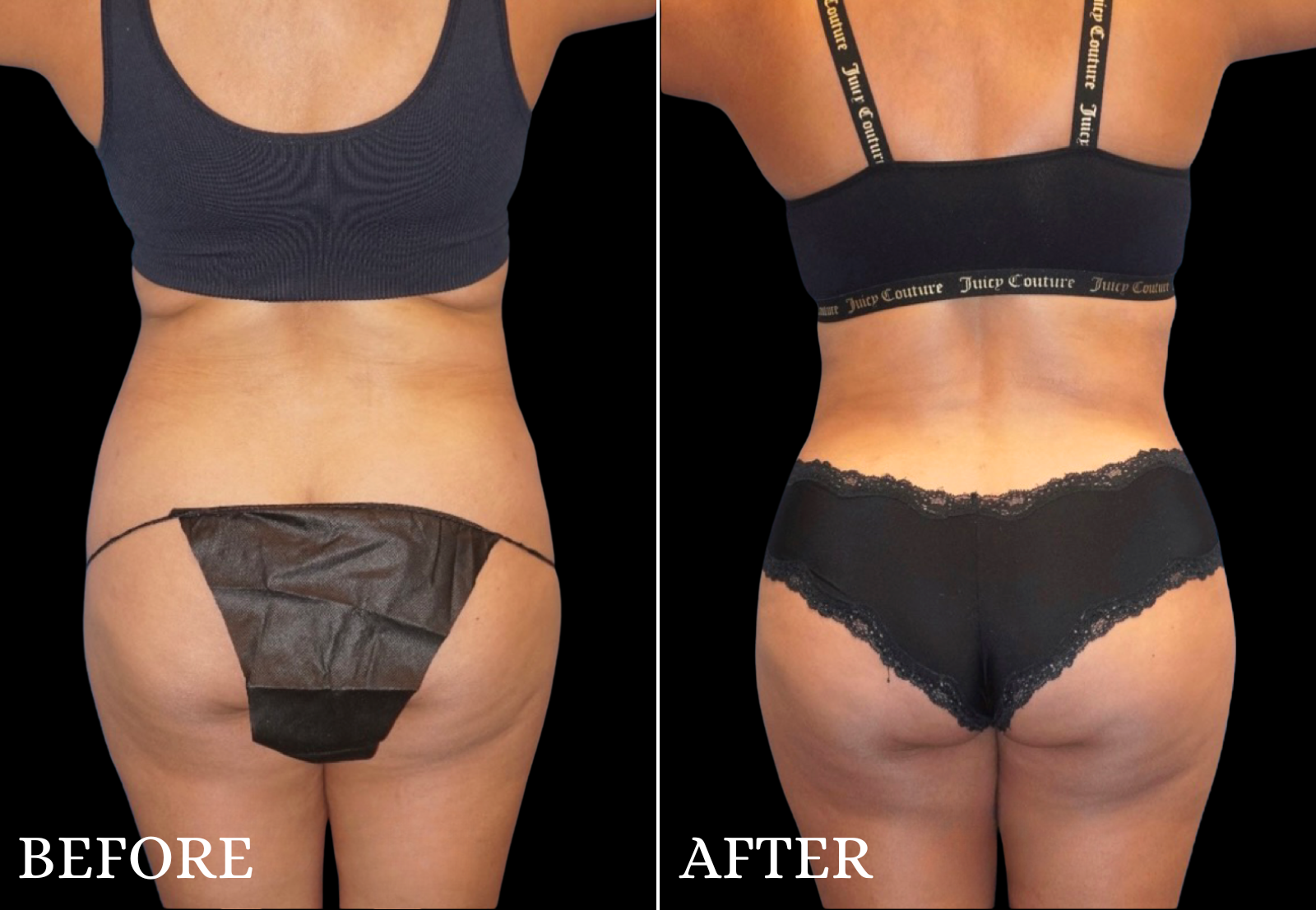 Liposuction Before & After Gallery - Patient 109752 - Image 2