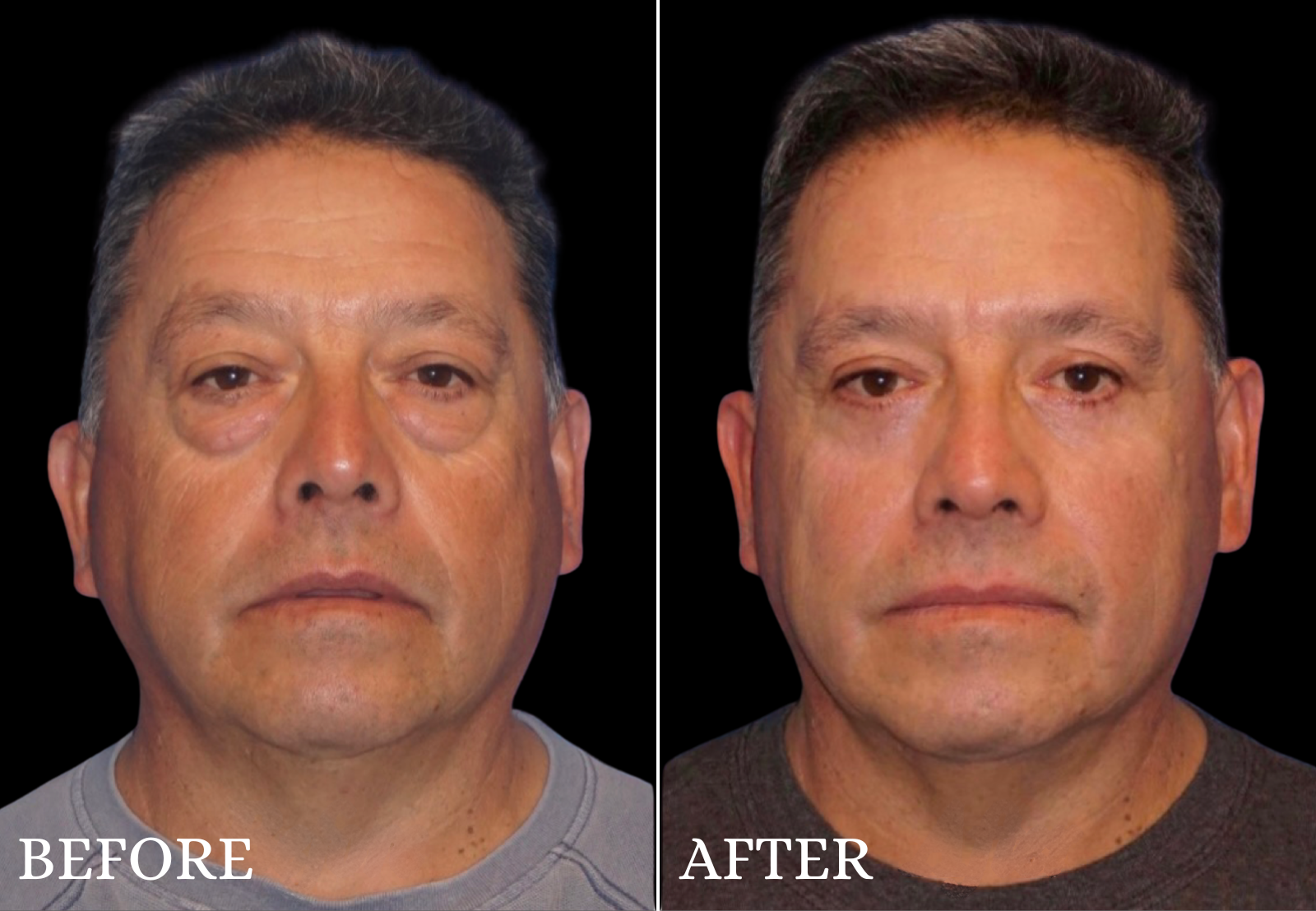 Lower Blepharoplasty Before & After Gallery - Patient 259892 - Image 1