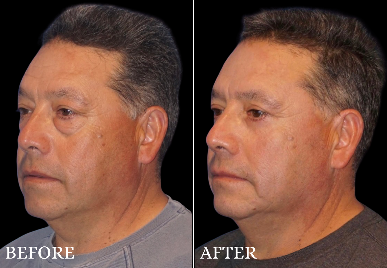 Lower Blepharoplasty Before & After Gallery - Patient 259892 - Image 4