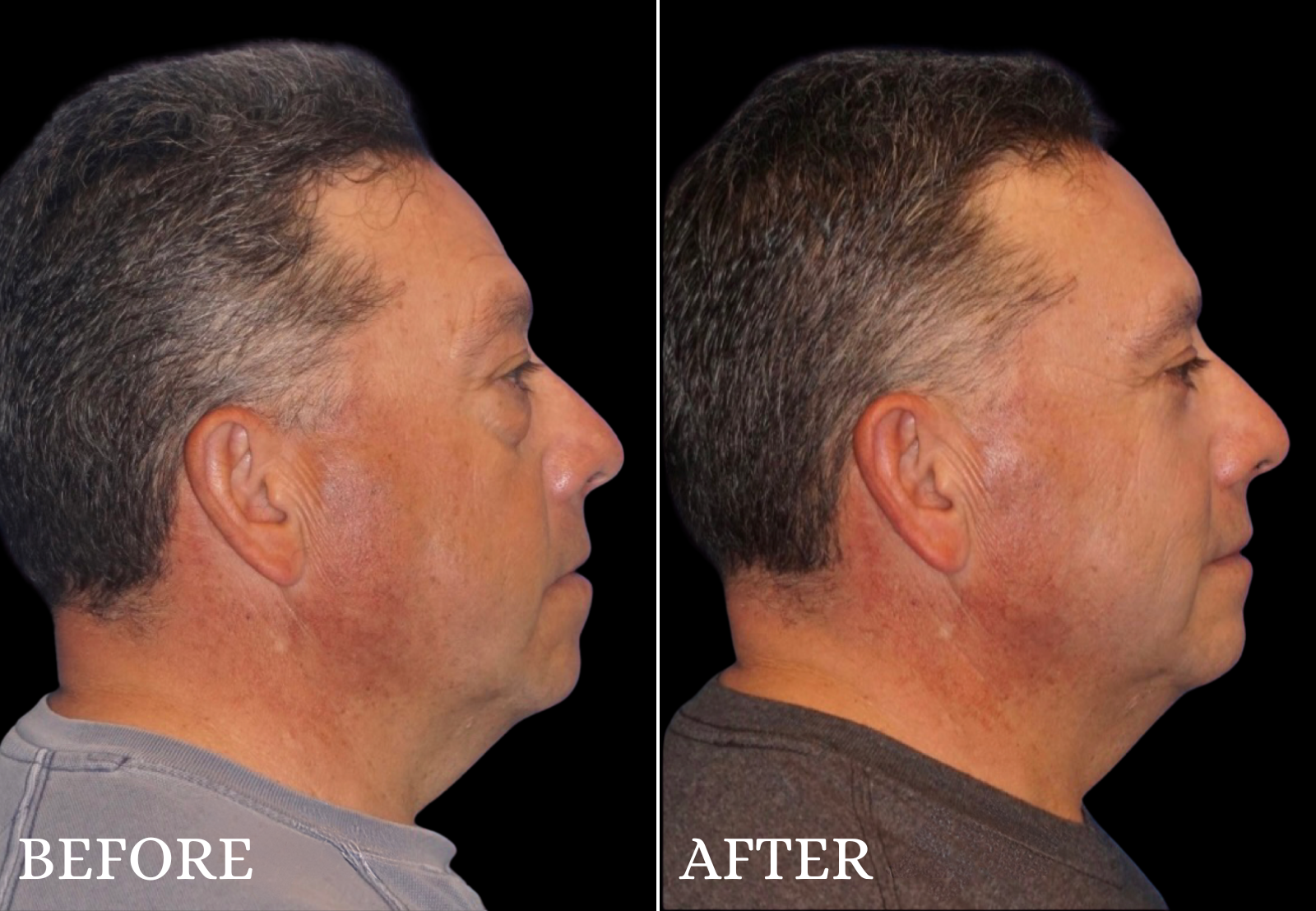 Lower Blepharoplasty Before & After Gallery - Patient 259892 - Image 3