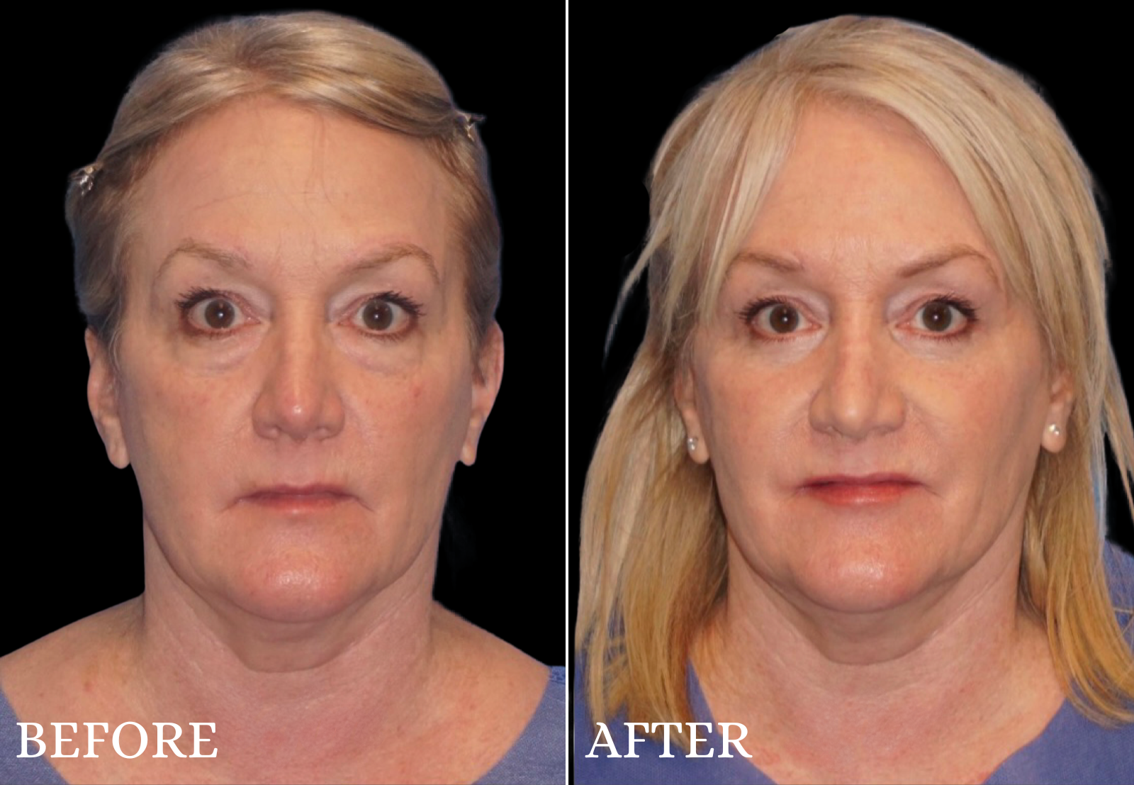 Lower Blepharoplasty Before & After Gallery - Patient 377536 - Image 2