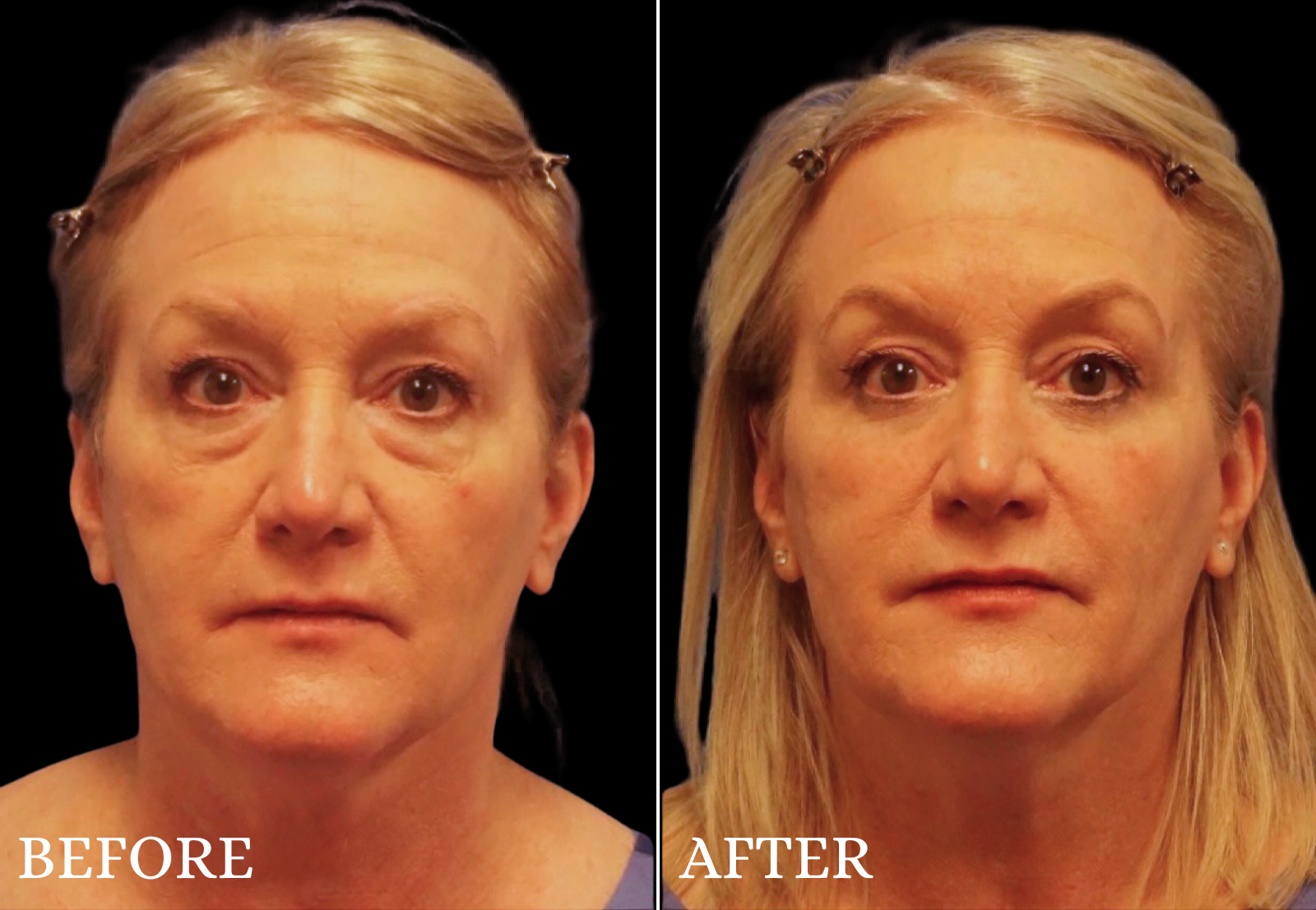 Lower Blepharoplasty Before & After Gallery - Patient 377536 - Image 1