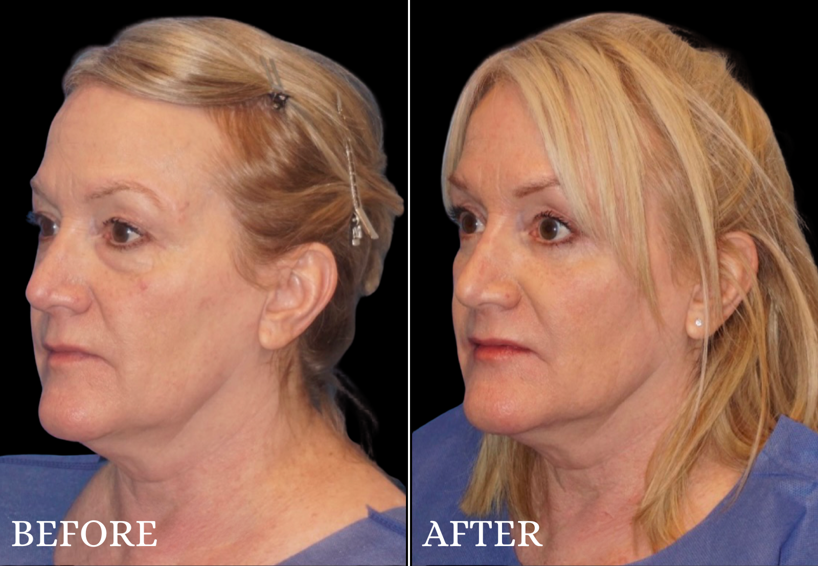 Lower Blepharoplasty Before & After Gallery - Patient 377536 - Image 4