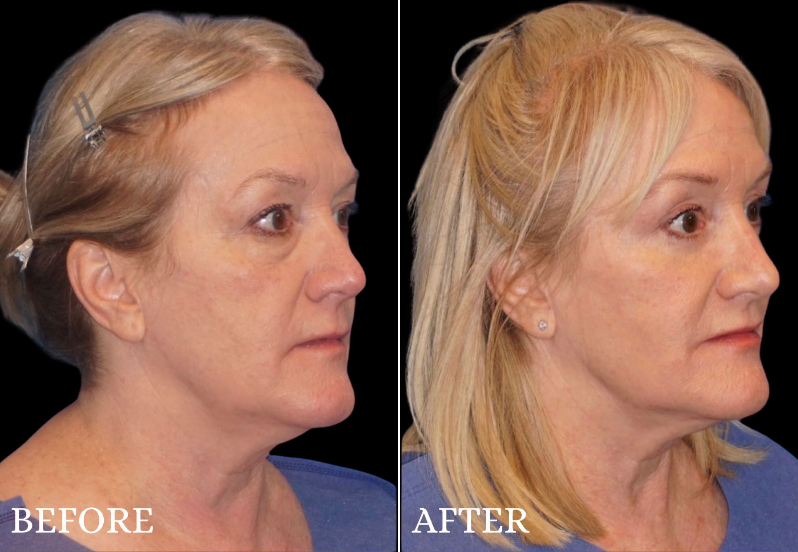 Lower Blepharoplasty Before & After Gallery - Patient 377536 - Image 3
