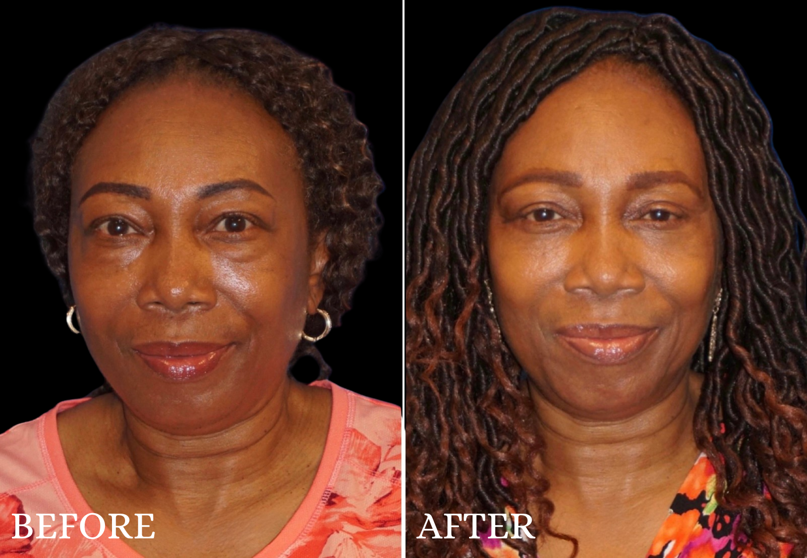 Lower Blepharoplasty Before & After Gallery - Patient 168432 - Image 1