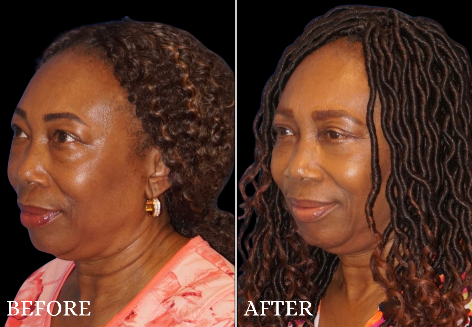 Lower Blepharoplasty Before & After Gallery - Patient 168432 - Image 3
