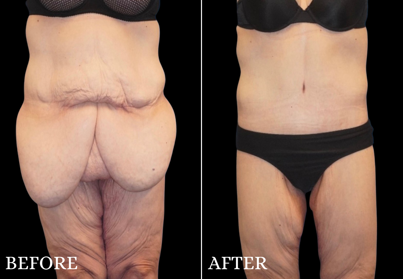 Massive Weight Loss Before & After Gallery - Patient 142343 - Image 1