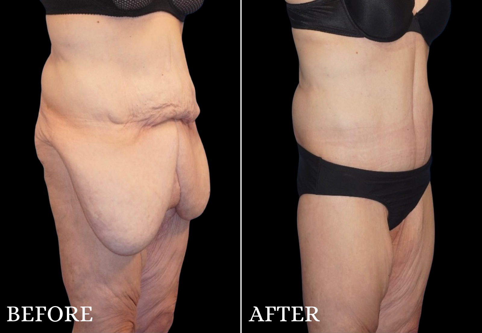 Massive Weight Loss Before & After Gallery - Patient 142343 - Image 2