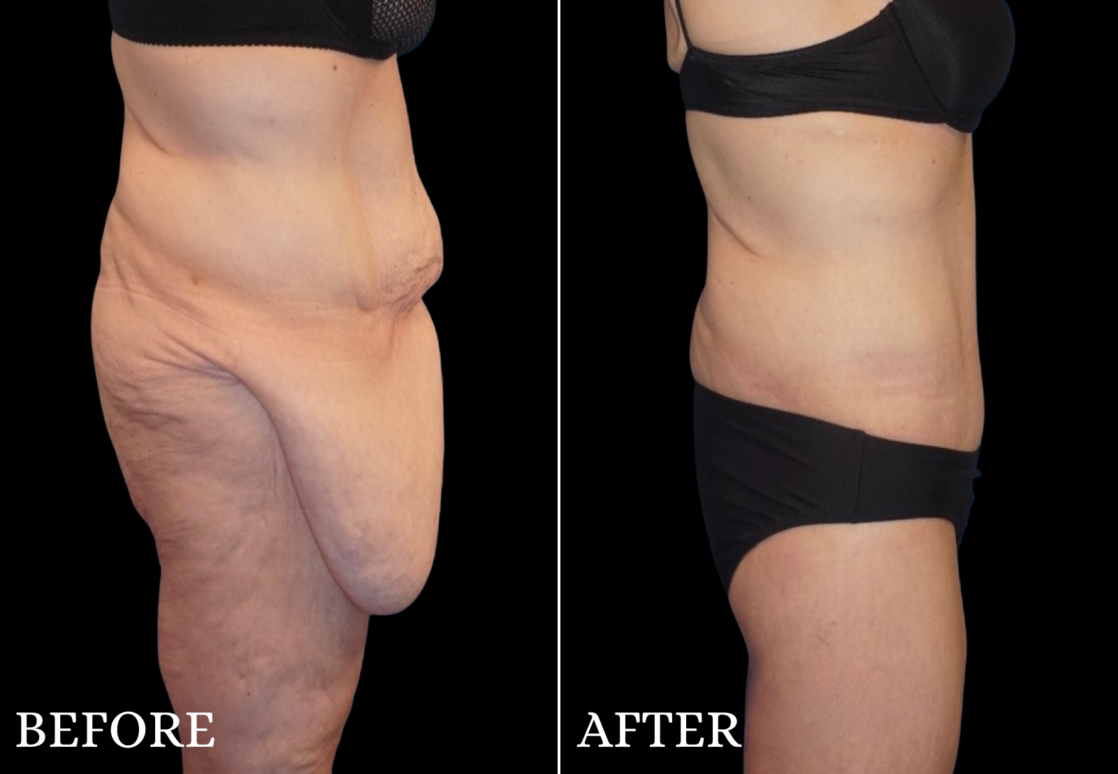 Massive Weight Loss Before & After Gallery - Patient 142343 - Image 3