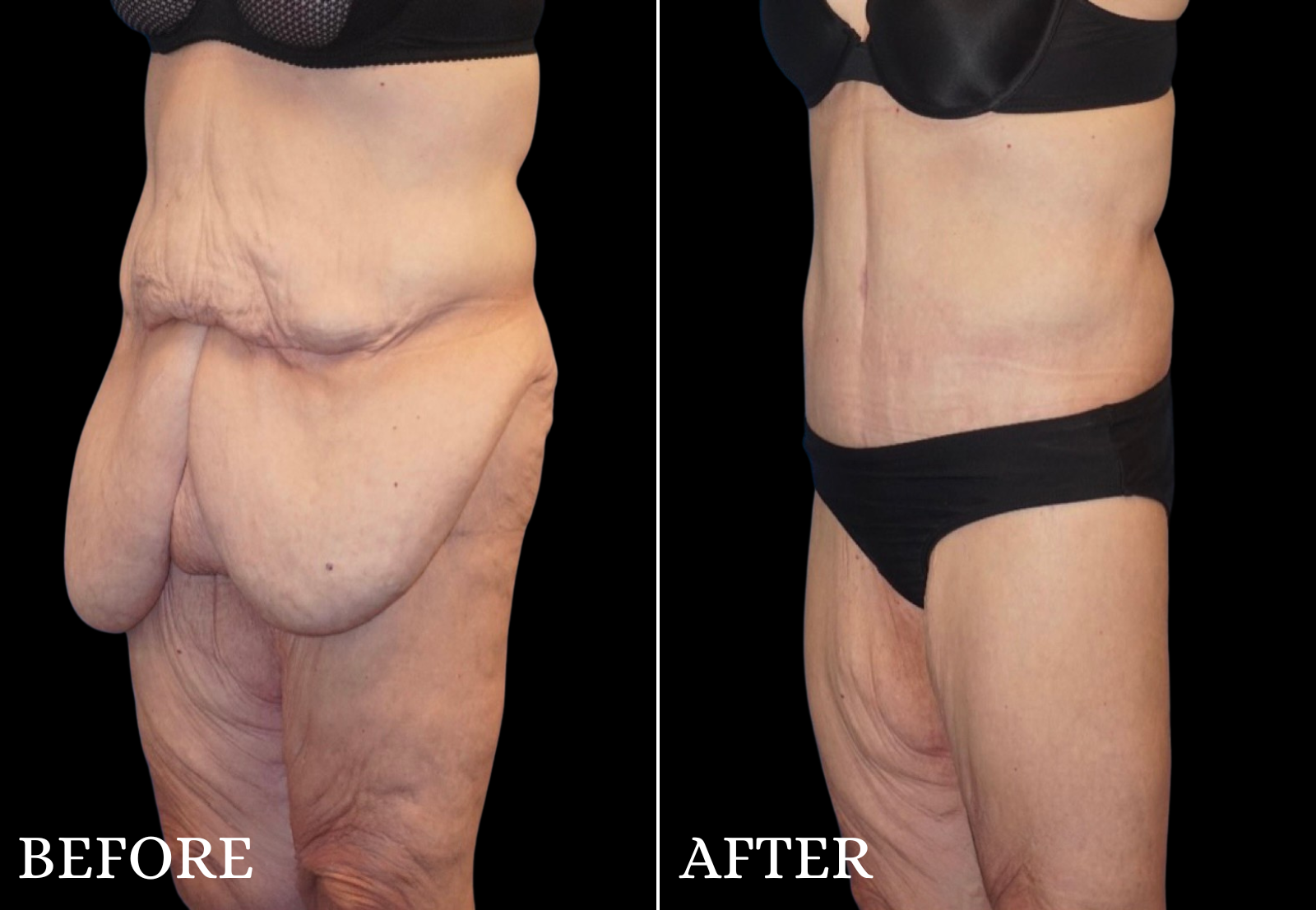 Massive Weight Loss Before & After Gallery - Patient 142343 - Image 4