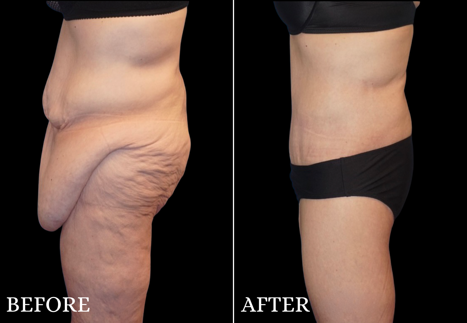 Massive Weight Loss Before & After Gallery - Patient 142343 - Image 5