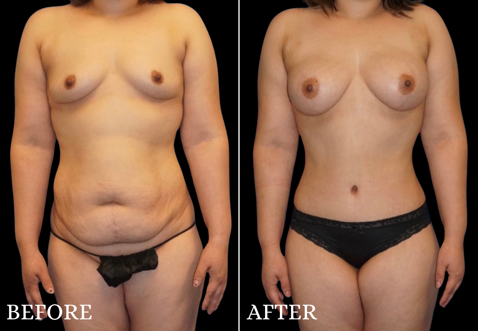 Mommy Makeover Before & After Gallery - Patient 326033 - Image 1