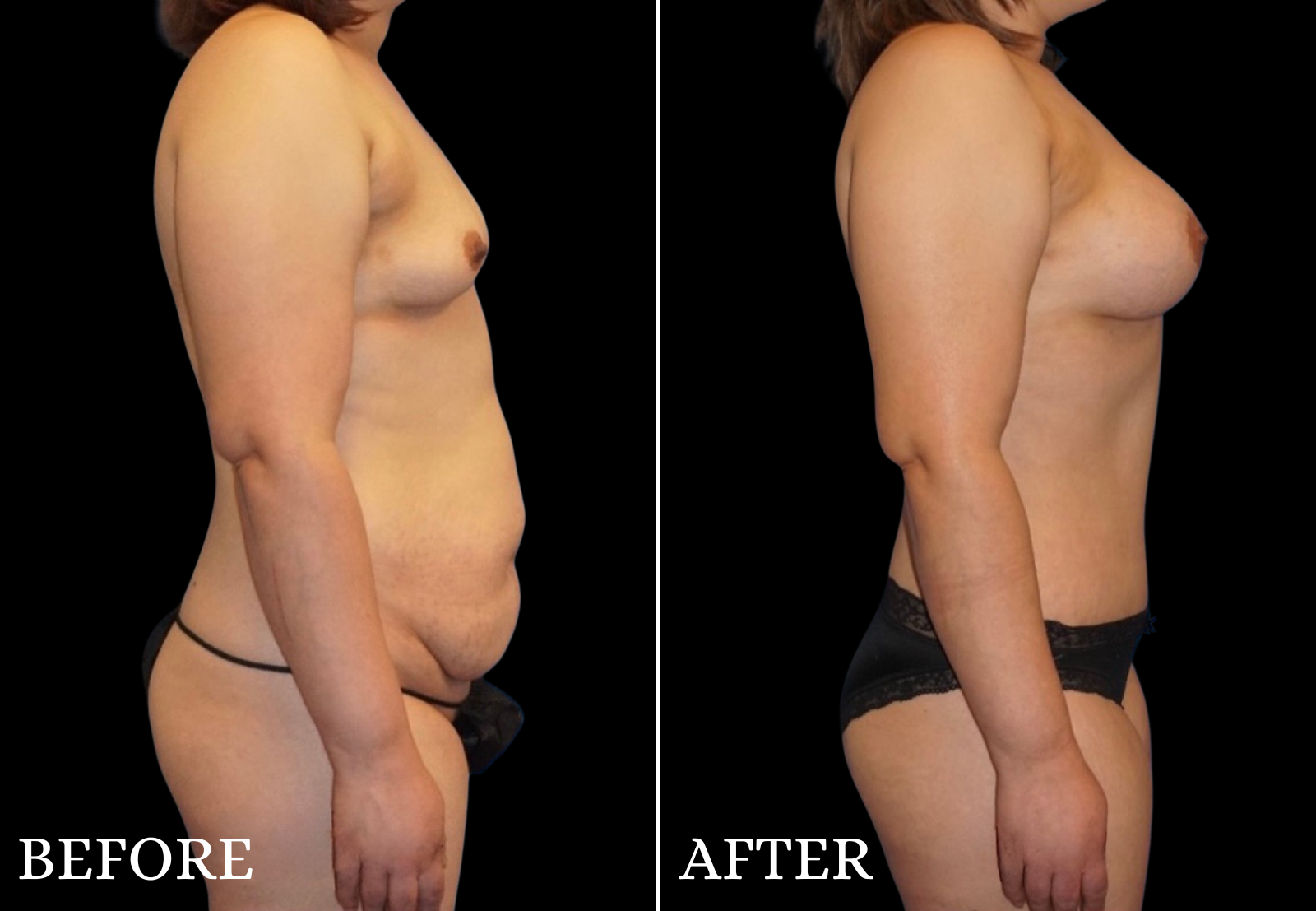 Mommy Makeover Before & After Gallery - Patient 326033 - Image 3